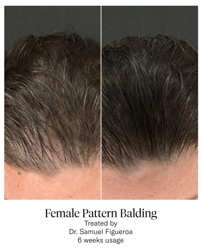 CALECIM PROFESSIONAL ADVANCED HAIR SYSTEM 6x5ml plus Home Activator - AtsiHairSupplies